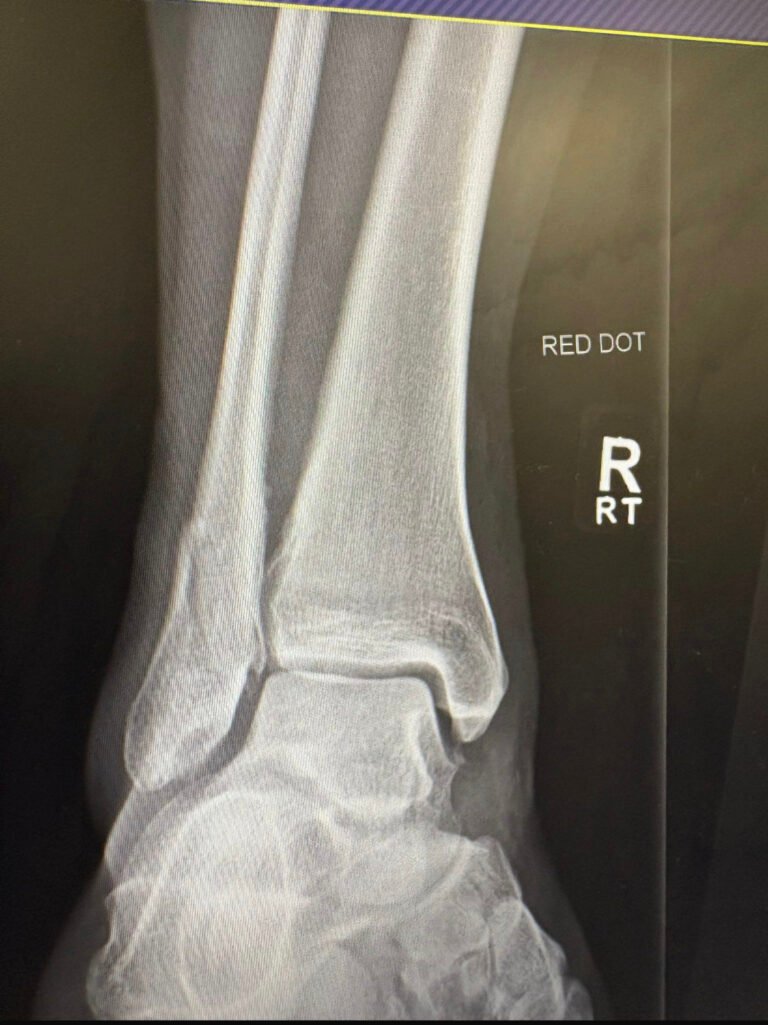 Double ankle fracture X-ray Billy Gillies ultramarathon training injury January 2026
